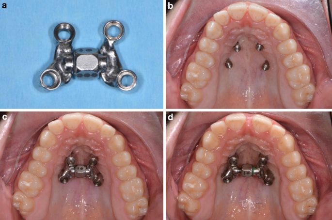 Procedure using CAD/CAM-manufactured insertion guides for purely  mini-implant-borne rapid maxillary expanders