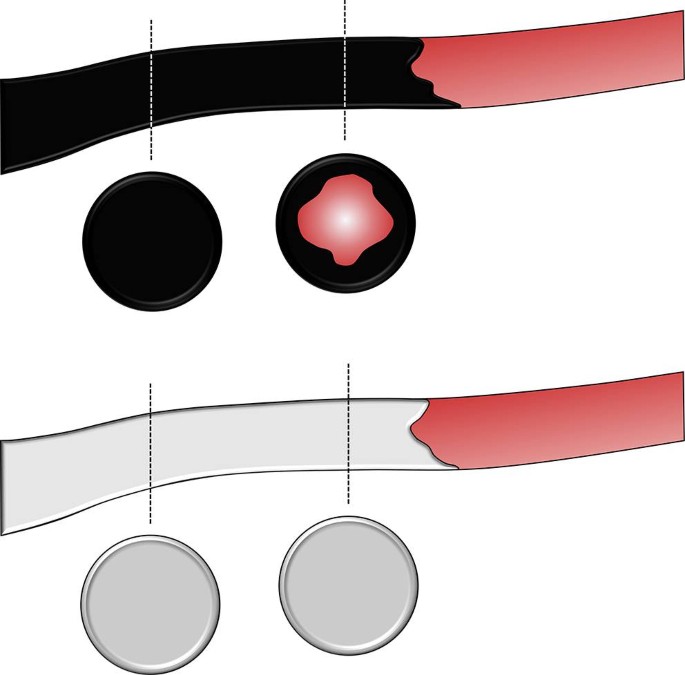 A) Preparation of DC-beads and lipiodol embolic agents currently in