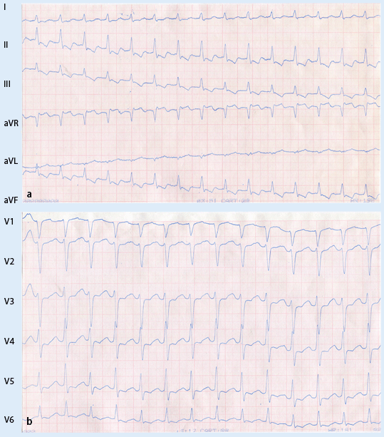 antidrome wpw 12 Kanal EKG