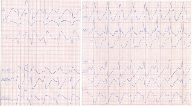 antidrome wpw 12 Kanal EKG