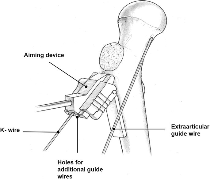 Femoral head necrosis therapy instrument moxibustion massage