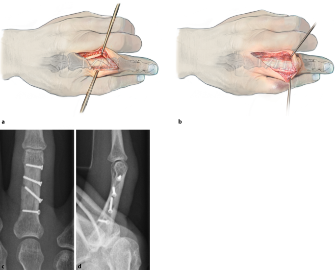 Offene Reposition und Schrauben‑/Plattenosteosynthese von  Fingergrundgliedfrakturen | Operative Orthopädie und Traumatologie