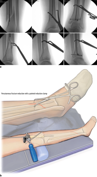 Intramedullary nailing of extra-articular proximal tibia fractures -  Document - Gale Academic OneFile