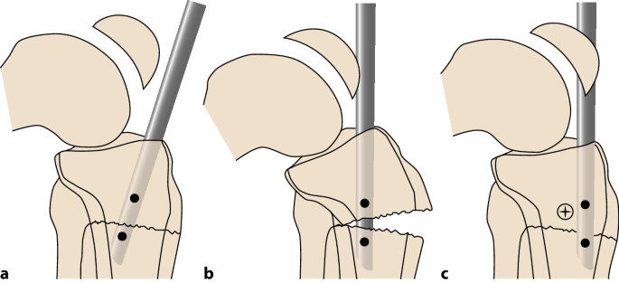 Comparison of suprapatellar intramedullary nailing versus minimal invasive  locked plating for proximal tibia fractures | Archives of Orthopaedic and  Trauma Surgery