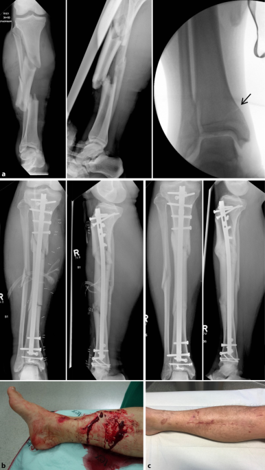Far Proximal and Far Distal Tibial Fractures: Management with  Intramedullary Nails | IntechOpen