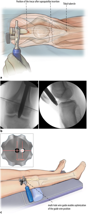 Extreme Nailing or Less Invasive Plating of Lower Extremity Periarticular  Fractures