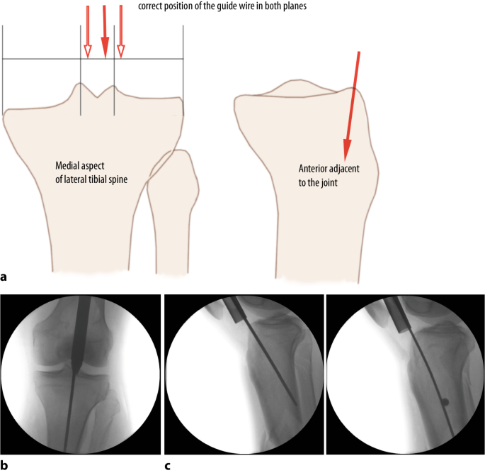 Accurate Entry Point for Tibial Nailing with SIGN Nail in Asians: A  Cadaveric Study | Semantic Scholar