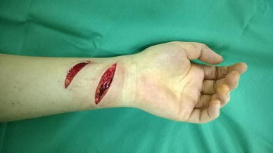 Analysis of 41 suicide attempts by wrist cutting: a retrospective analysis  | European Journal of Trauma and Emergency Surgery