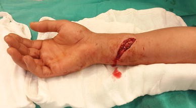 Analysis of 41 suicide attempts by wrist cutting: a retrospective analysis  | European Journal of Trauma and Emergency Surgery