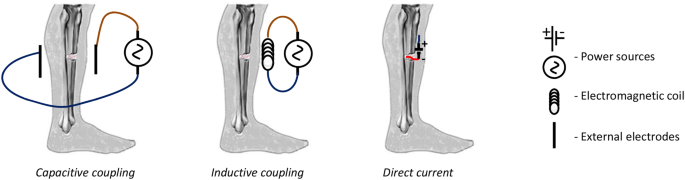 Electrical stimulation in bone tissue engineering treatments