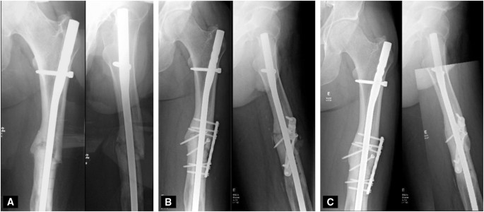 Intramedullary Nailing of Proximal Quarter Tibial Fractures