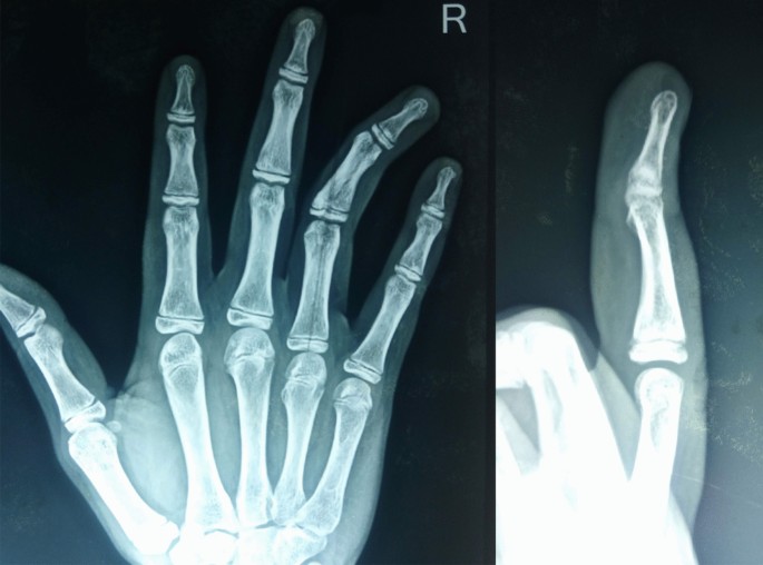 Long-term results following osteotomy of the thumb delta phalanx