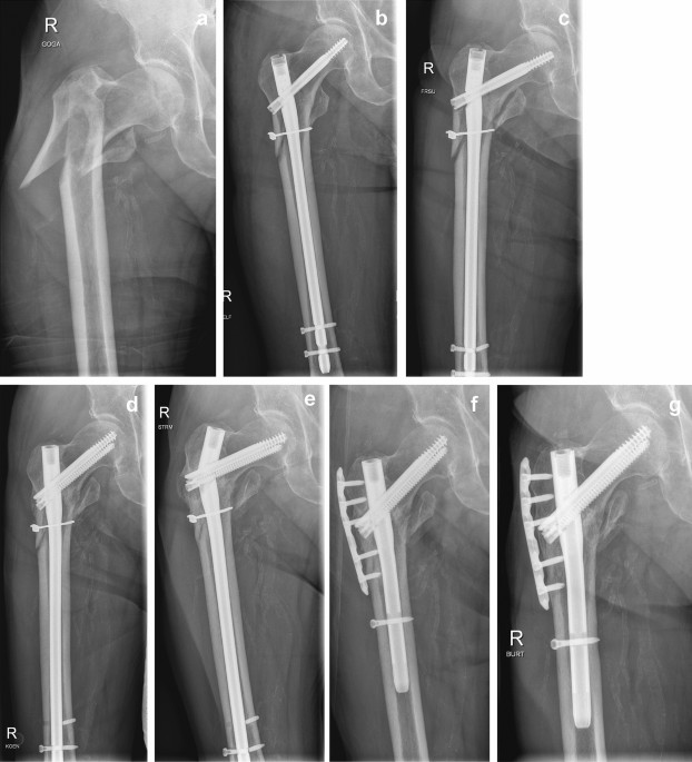 Designing composite external fixator for intertrochanteric fracture  treatment based on Vietnamese femur morphological parameters | Russian Open  Medical Journal