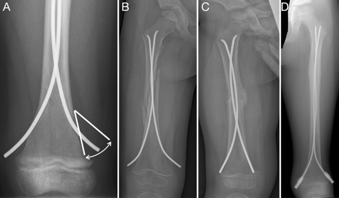 Pediatric Femoral Shaft Fracture: An Age-Based Treatment Algorithm