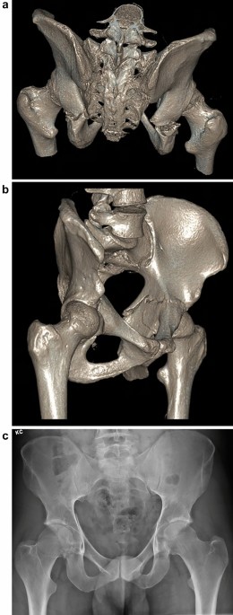 Figure, Pelvic ring injuries Image courtesy Dr Chaigasame] - StatPearls -  NCBI Bookshelf