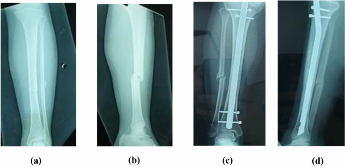 Medical Apparatus Imaging Guide: fracture fixation