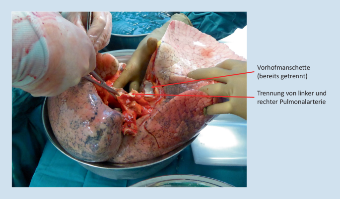 Lungentransplantation: aktueller Stand und Entwicklungen | Die Chirurgie |  Springer Nature Link