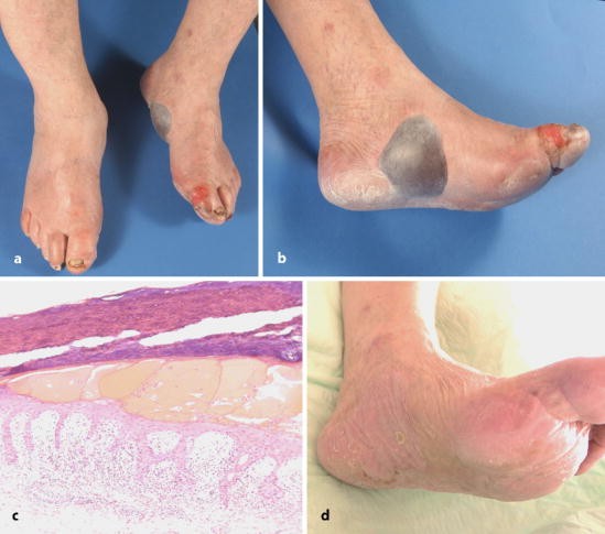 Hand-Fuß-Syndrom bei einem Patienten unter Capecitabin-Therapie | Die  Dermatologie