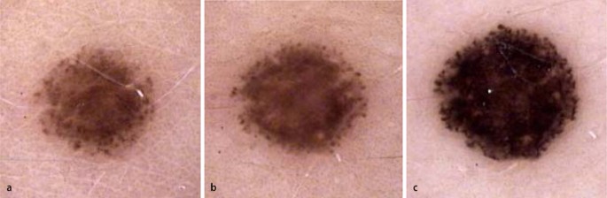 does melanotan cause freckles Treating Pigmented Lesions