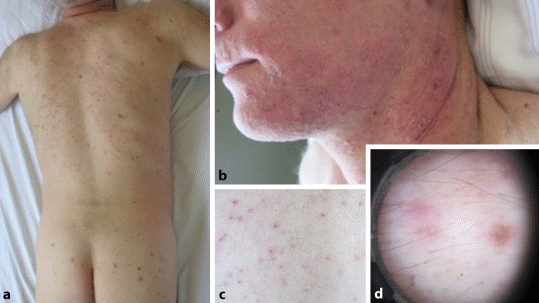 Stark juckender eruptiver Hautausschlag bei einem mnnlichen Patienten |  Die Dermatologie | Springer Nature Link