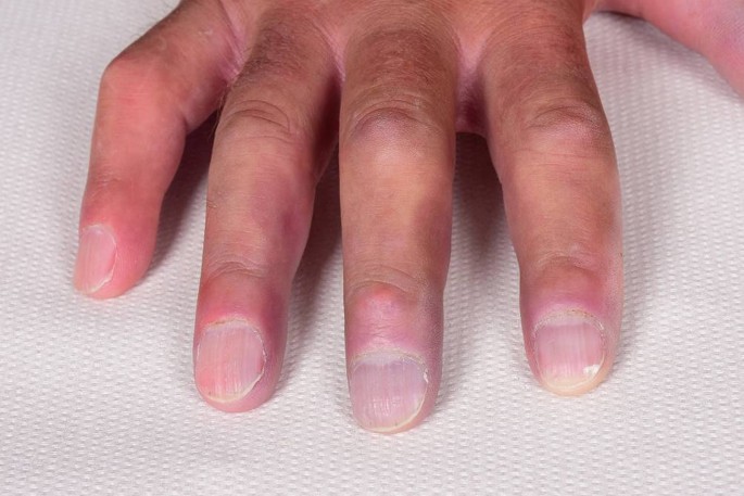 Nagelvernderungen bei entzndlichen Dermatosen: Erkennen und behandeln |  Die Dermatologie | Springer Nature Link