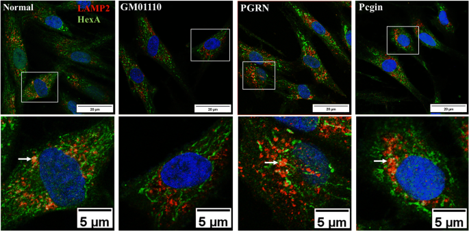 Progranulin associates with hexosaminidase A and ameliorates GM2  ganglioside accumulation and lysosomal storage in Tay-Sachs disease |  Journal of Molecular Medicine