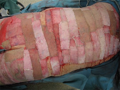 Hautersatzverfahren in der Verbrennungschirurgie | Die Unfallchirurgie |  Springer Nature Link