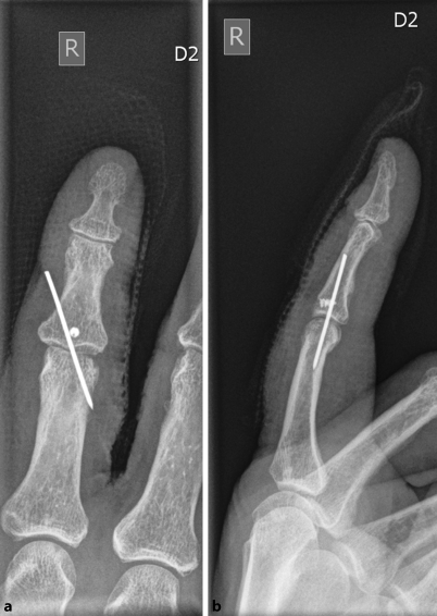 Finger verbinden nach Verstauchung (Distorsion) Finger Luxation
