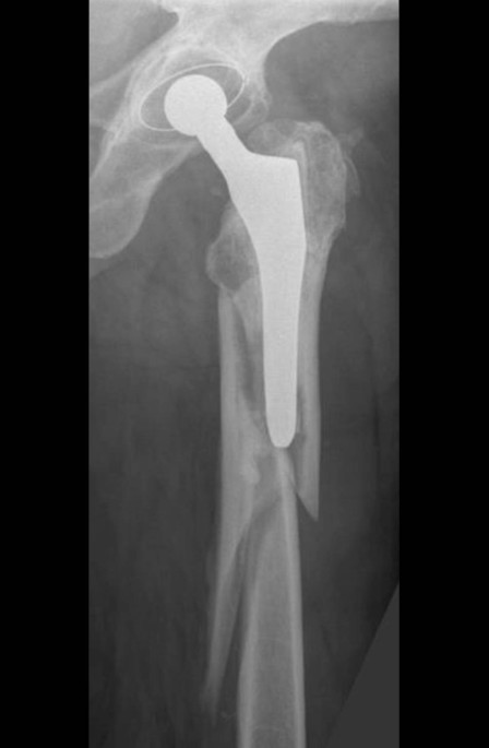 71/m  Sturz auf die Hfte bei einliegender Hfttotalendoprothese | Die  Unfallchirurgie | Springer Nature Link