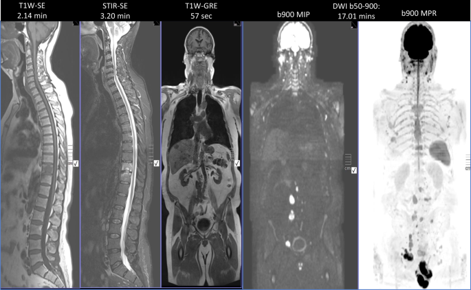 Bone Metastases Images and Xrays