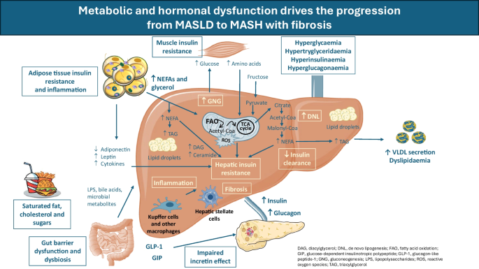 Metabolic drivers of MASLD and MASH: from hormonal imbalance to fibrosis | Diabetologia