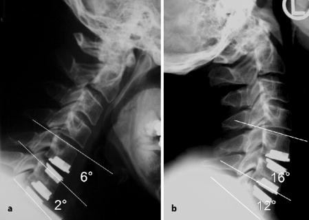 Zervikale Bandscheibenprothesen | Die Orthopdie | Springer Nature Link