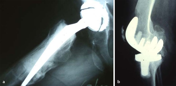 Rehabilitation nach endoprothetischem Ersatz von Hfte und Knie | Die  Orthopdie | Springer Nature Link
