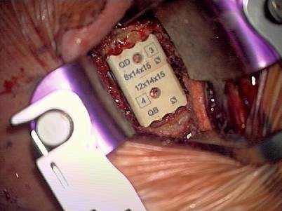 PEEK-Cage-Fusion nach anteriorer zervikaler Korporektomie | Die Orthopdie  | Springer Nature Link