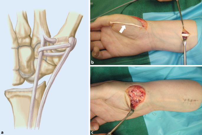 Minimal-invasive Verfahren im Frhstadium der Daumensattelgelenksarthrose |  Die Orthopdie | Springer Nature Link