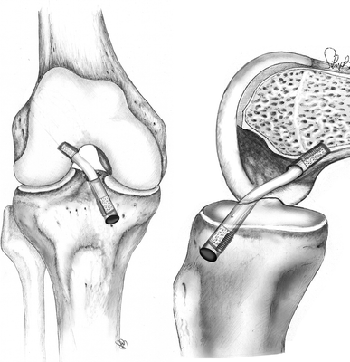 ACL Reconstruction Patellar Tendon