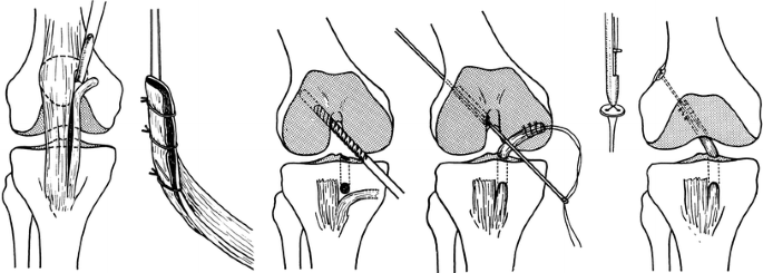 Surgery for anterior cruciate ligament deficiency: a historical perspective