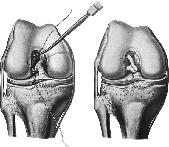 Arthroscopic picture of left knee revealing (a) bulky anterior cruciate