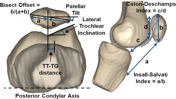 Anatomical factors influencing patellar tracking in the unstable  patellofemoral joint