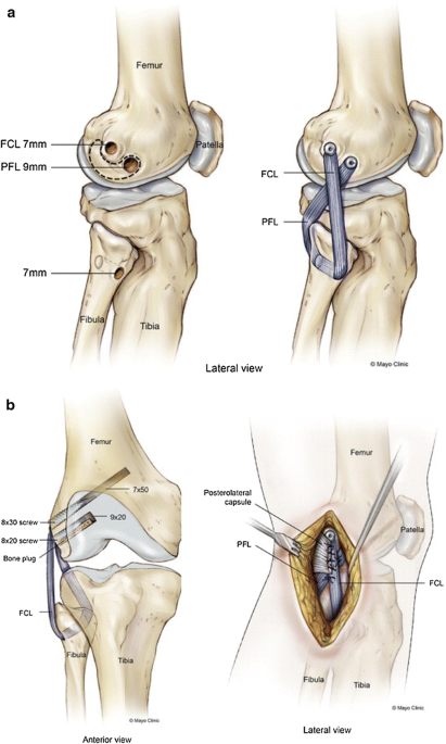 MCL Tear: Medial Collateral Ligament Injury