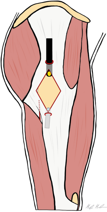 External Snapping Hip Syndrome (Iliotibial Band Syndrome) – Hip  Preservation Institute