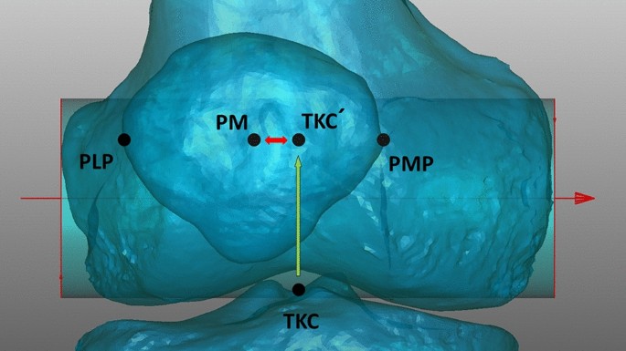 RadioGraphics - Patellar Tracking: An Old Problem with New Insights June 1,  2023 Figure 1. Three-dimensional (3D) illustrations show key…