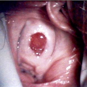 Urethral Mucosal Prolapse  Northeast Ohio Urogynecology