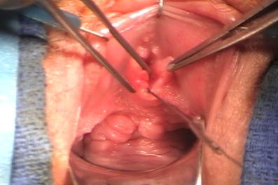 Surgical management of Skene's gland abscess/infection: a contemporary  series | International Urogynecology Journal