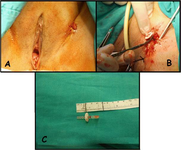 Groin abscess due to a forgotten midurethral sling connector |  International Urogynecology Journal