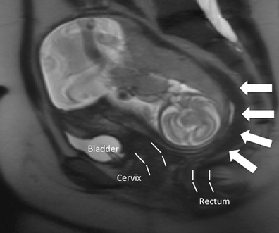 Acute urinary retention due to a nonincarcerated retroverted