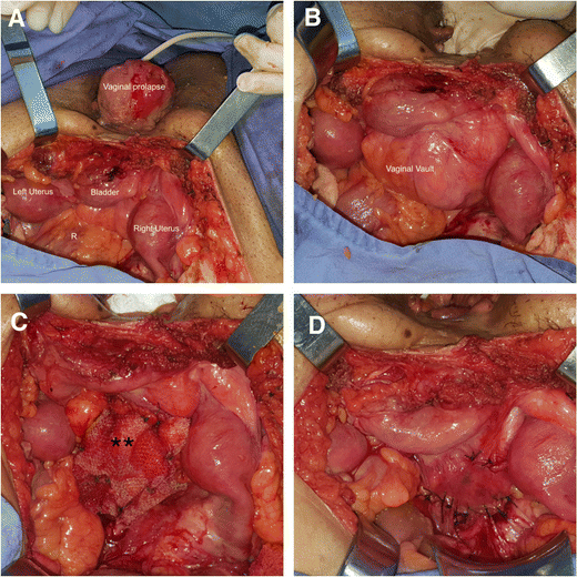 Vaginal prolapse in bladder exstrophy with complete duplication of the  uterus