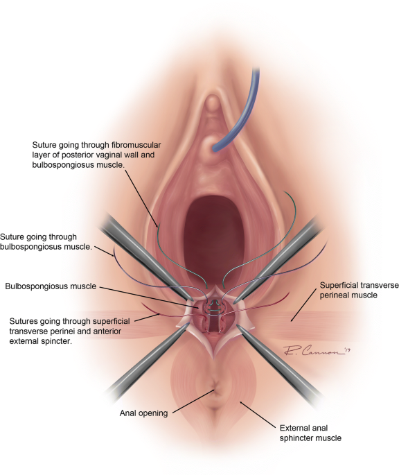 Joint Report on Terminology for Cosmetic Gynecology