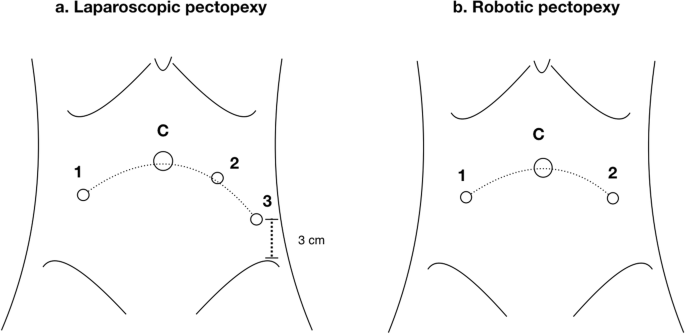 Laparoscopic Non-Mesh Cerclage Pectopexy for Pelvic Organ Prolapse