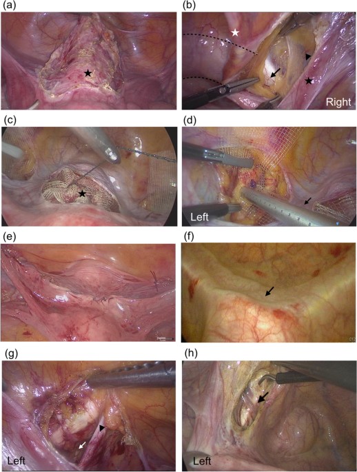 Laparoscopic Non-Mesh Cerclage Pectopexy for Pelvic Organ Prolapse